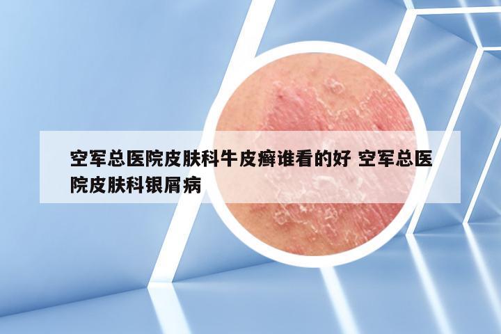 空军总医院皮肤科牛皮癣谁看的好 空军总医院皮肤科银屑病