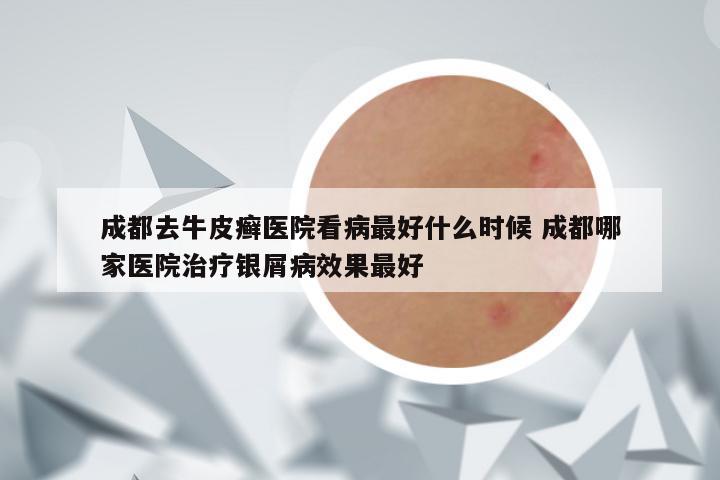 成都去牛皮癣医院看病最好什么时候 成都哪家医院治疗银屑病效果最好