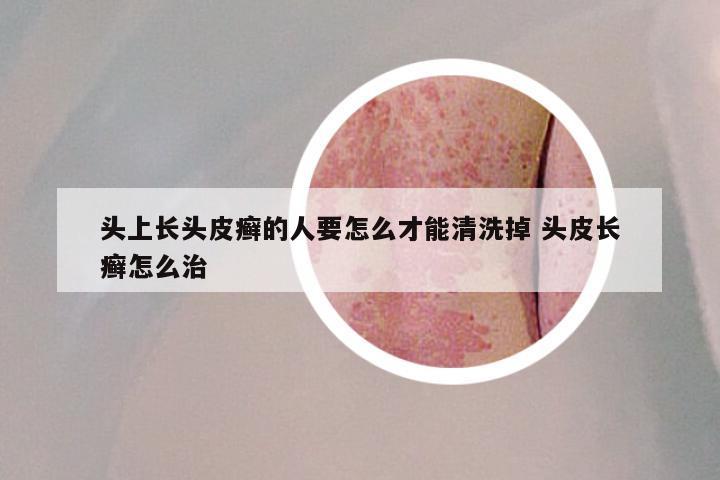 头上长头皮癣的人要怎么才能清洗掉 头皮长癣怎么治