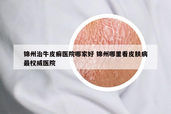 锦州治牛皮癣医院哪家好 锦州哪里看皮肤病最权威医院