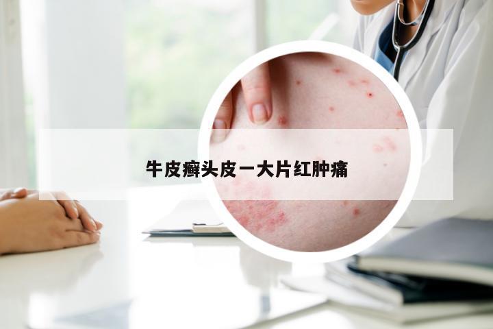 牛皮癣头皮一大片红肿痛
