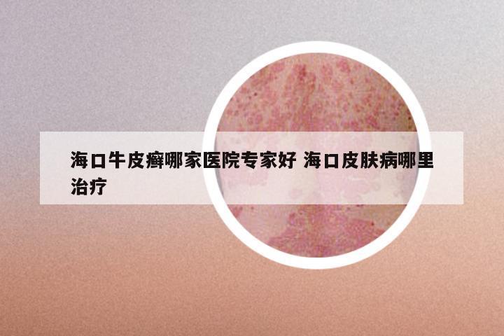 海口牛皮癣哪家医院专家好 海口皮肤病哪里治疗