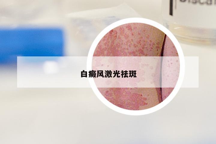 白癜风激光祛斑