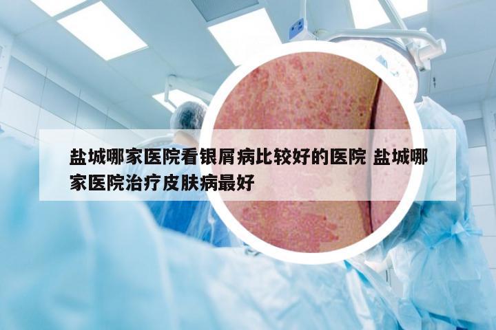 盐城哪家医院看银屑病比较好的医院 盐城哪家医院治疗皮肤病最好