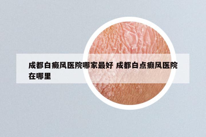 成都白癜风医院哪家最好 成都白点癫风医院在哪里
