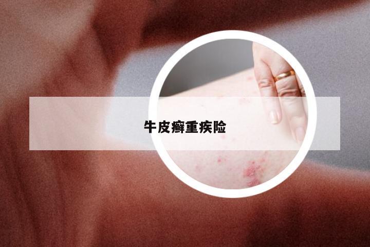 牛皮癣重疾险