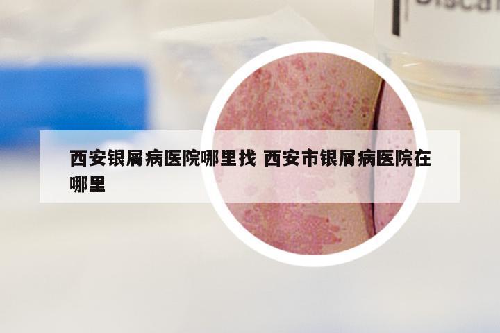 西安银屑病医院哪里找 西安市银屑病医院在哪里