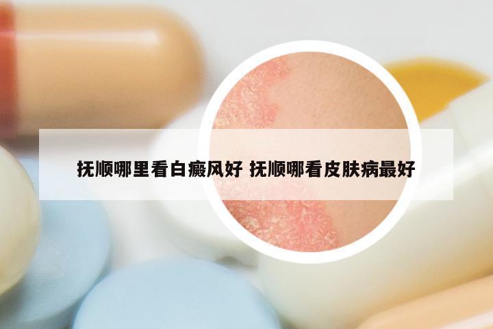抚顺哪里看白癜风好 抚顺哪看皮肤病最好
