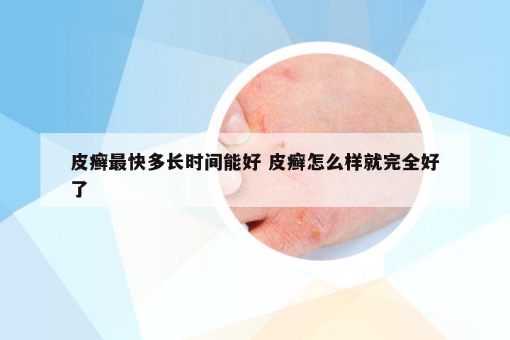 皮癣最快多长时间能好 皮癣怎么样就完全好了