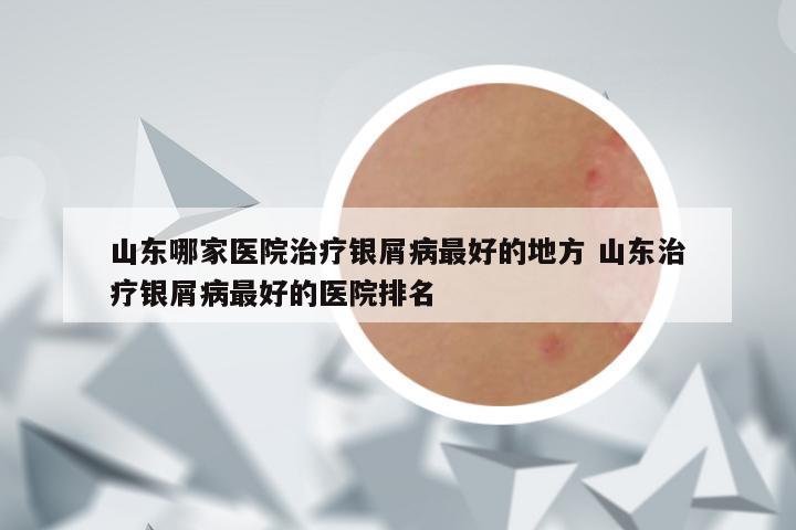 山东哪家医院治疗银屑病最好的地方 山东治疗银屑病最好的医院排名