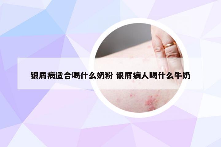 银屑病适合喝什么奶粉 银屑病人喝什么牛奶