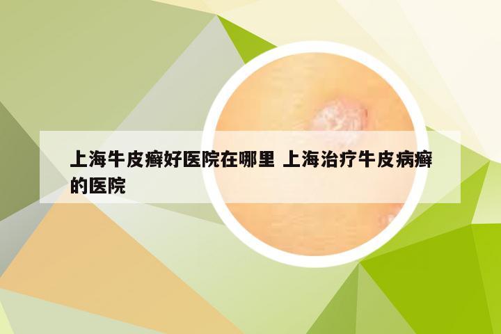 上海牛皮癣好医院在哪里 上海治疗牛皮病癣的医院