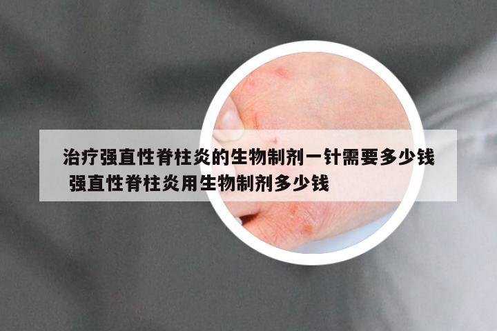 治疗强直性脊柱炎的生物制剂一针需要多少钱 强直性脊柱炎用生物制剂多少钱