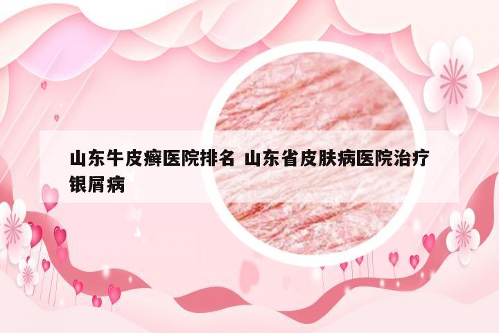山东牛皮癣医院排名 山东省皮肤病医院治疗银屑病