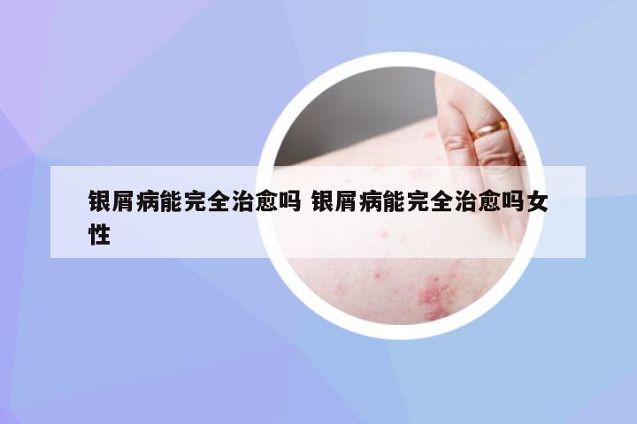 银屑病能完全治愈吗 银屑病能完全治愈吗女性