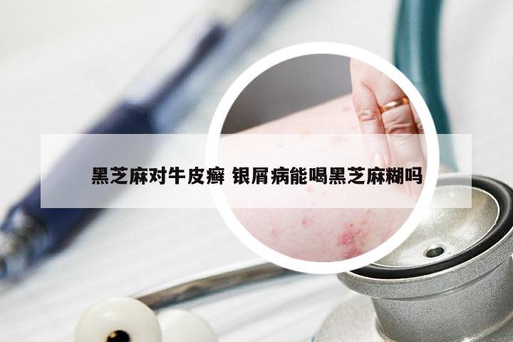 黑芝麻对牛皮癣 银屑病能喝黑芝麻糊吗