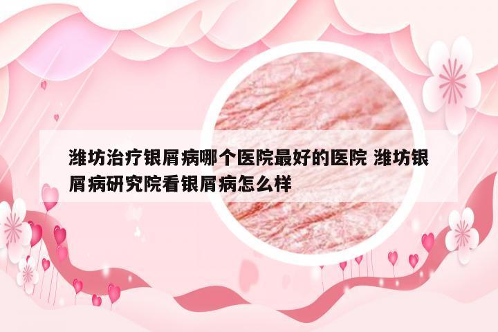 潍坊治疗银屑病哪个医院最好的医院 潍坊银屑病研究院看银屑病怎么样