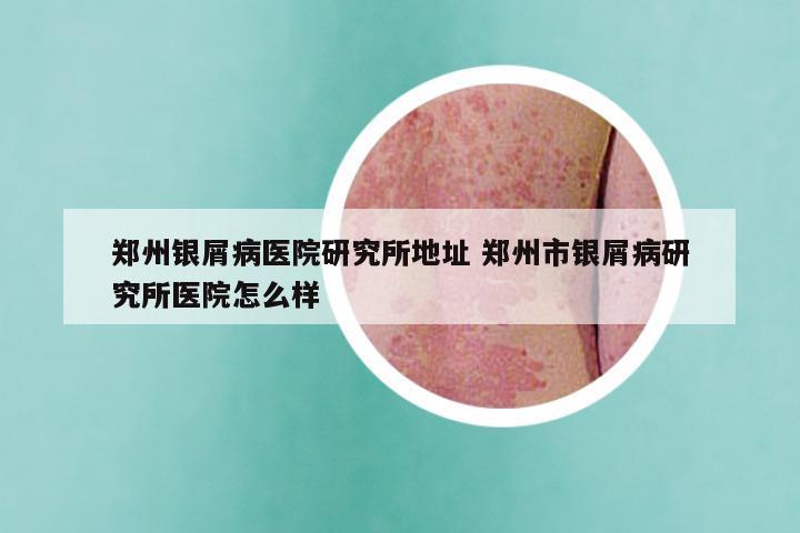 郑州银屑病医院研究所地址 郑州市银屑病研究所医院怎么样