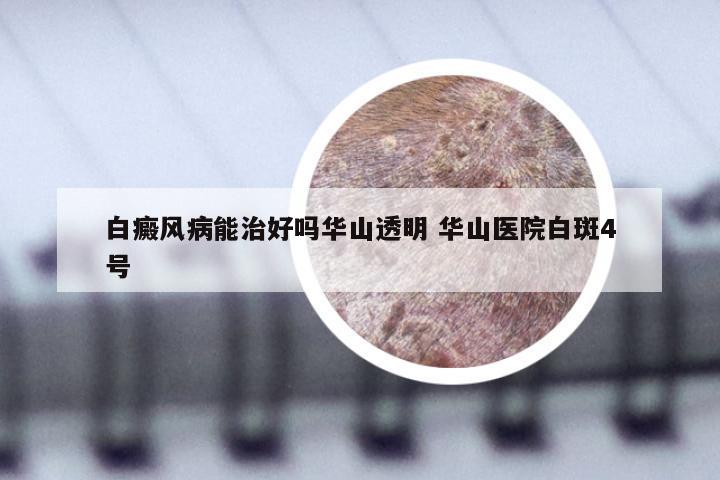白癜风病能治好吗华山透明 华山医院白斑4号