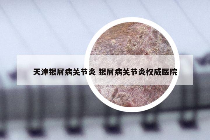 天津银屑病关节炎 银屑病关节炎权威医院