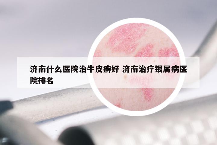 济南什么医院治牛皮癣好 济南治疗银屑病医院排名