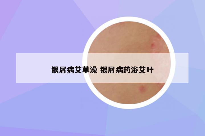 银屑病艾草澡 银屑病药浴艾叶