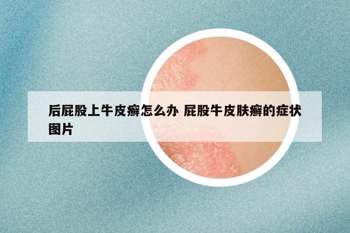 后屁股上牛皮癣怎么办 屁股牛皮肤癣的症状图片
