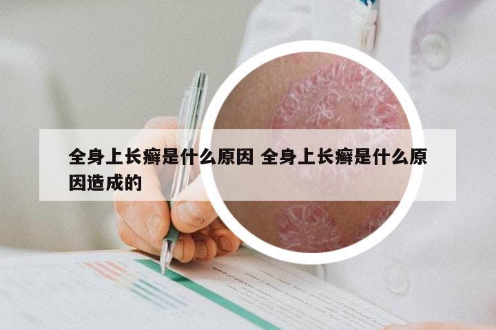 全身上长癣是什么原因 全身上长癣是什么原因造成的