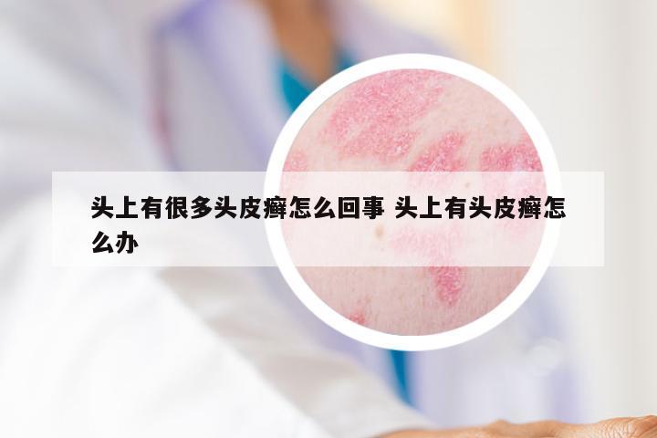 头上有很多头皮癣怎么回事 头上有头皮癣怎么办