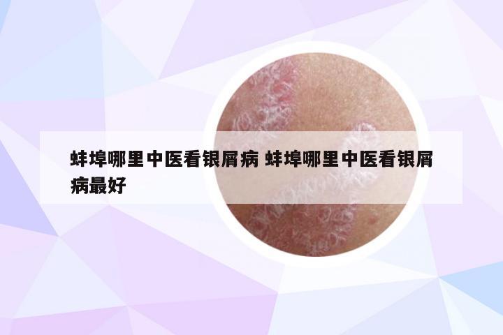 蚌埠哪里中医看银屑病 蚌埠哪里中医看银屑病最好
