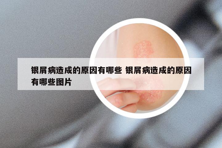 银屑病造成的原因有哪些 银屑病造成的原因有哪些图片