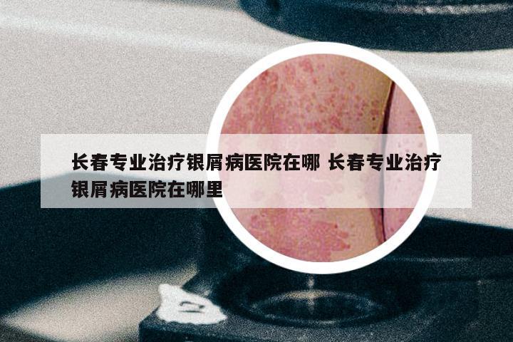 长春专业治疗银屑病医院在哪 长春专业治疗银屑病医院在哪里