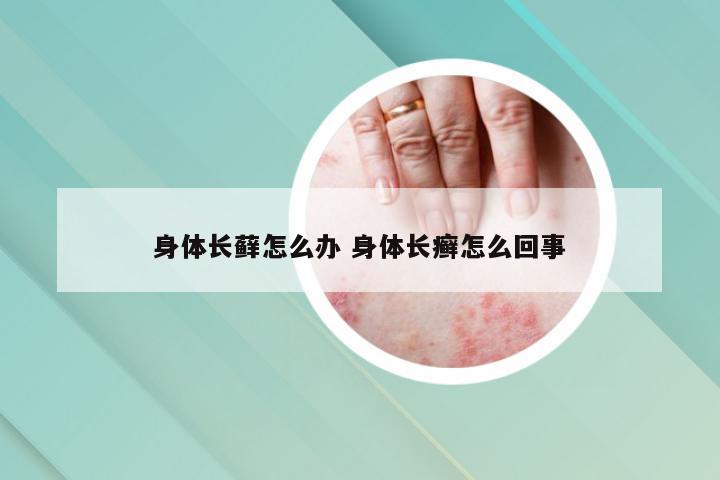 身体长藓怎么办 身体长癣怎么回事