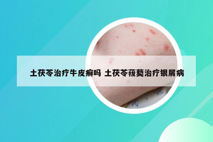 土茯苓治疗牛皮癣吗 土茯苓菝葜治疗银屑病