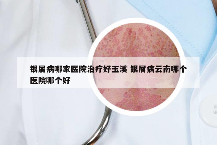 银屑病哪家医院治疗好玉溪 银屑病云南哪个医院哪个好