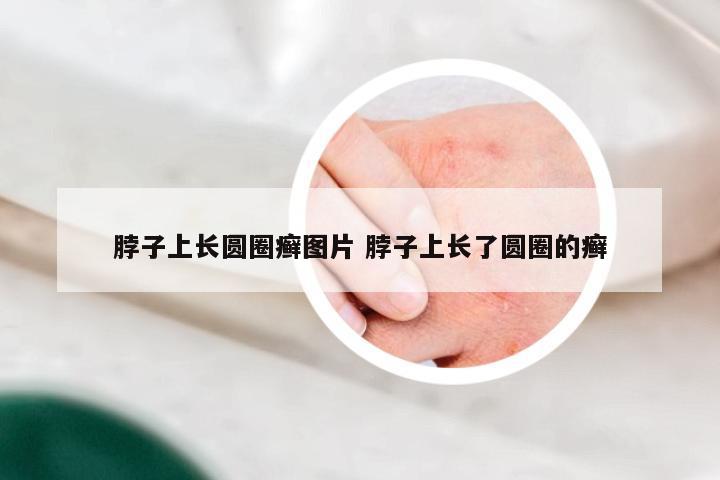 脖子上长圆圈癣图片 脖子上长了圆圈的癣