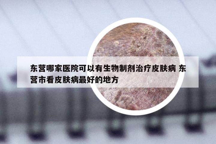 东营哪家医院可以有生物制剂治疗皮肤病 东营市看皮肤病最好的地方