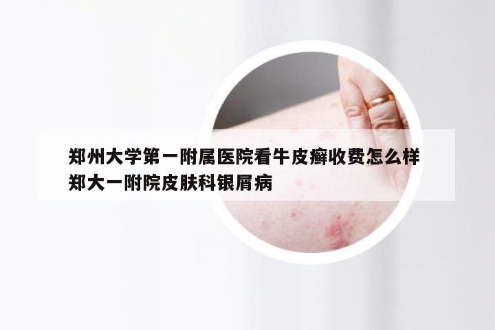 郑州大学第一附属医院看牛皮癣收费怎么样 郑大一附院皮肤科银屑病