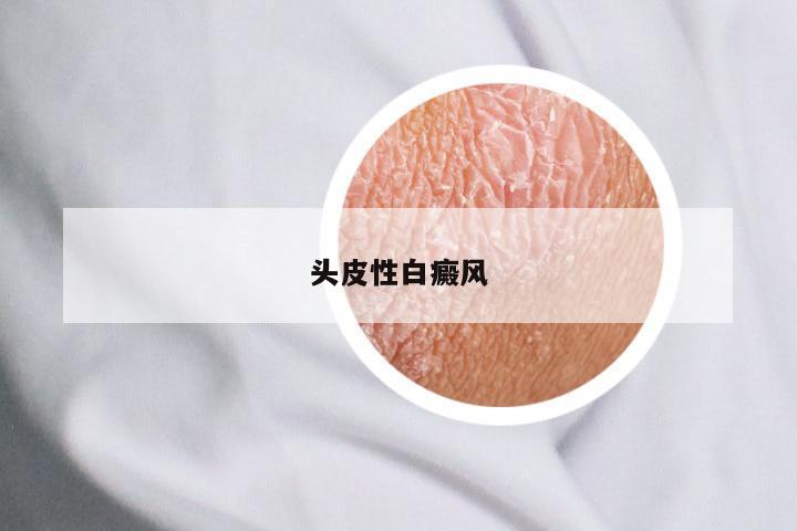 头皮性白癜风