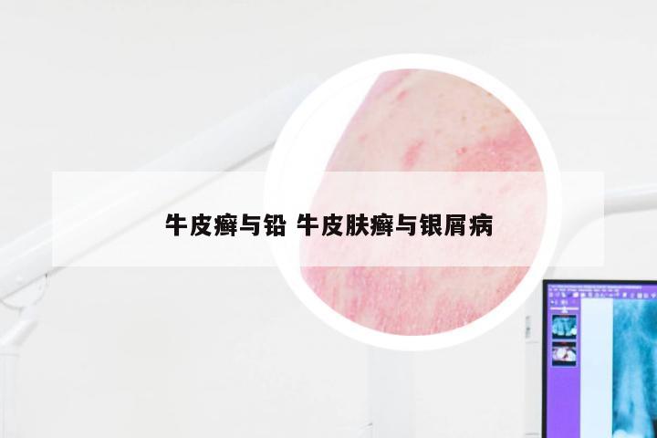 牛皮癣与铅 牛皮肤癣与银屑病