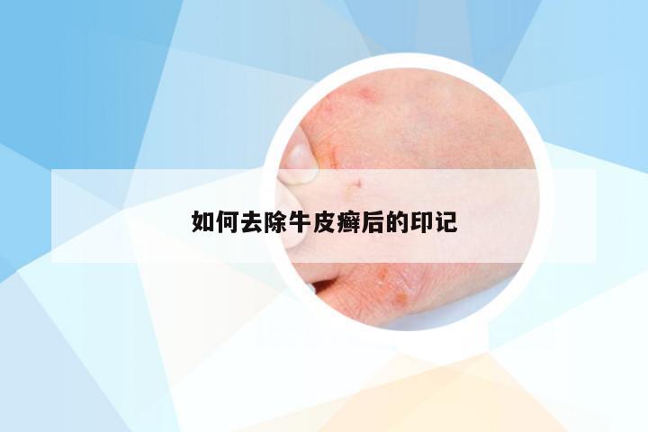 如何去除牛皮癣后的印记