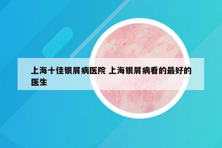 上海十佳银屑病医院 上海银屑病看的最好的医生