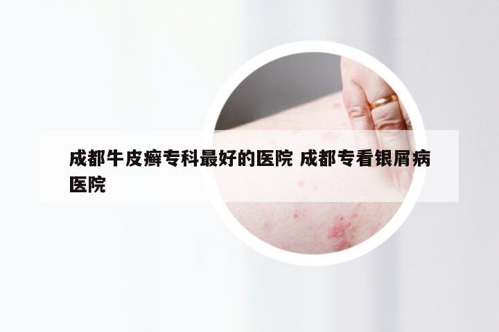 成都牛皮癣专科最好的医院 成都专看银屑病医院