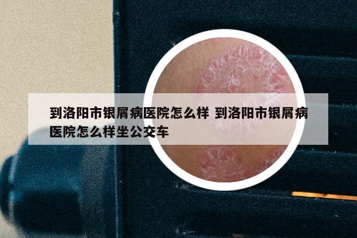 到洛阳市银屑病医院怎么样 到洛阳市银屑病医院怎么样坐公交车