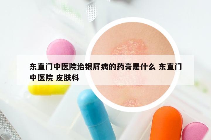 东直门中医院治银屑病的药膏是什么 东直门中医院 皮肤科