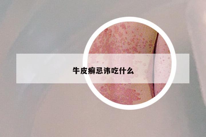 牛皮癣忌讳吃什么