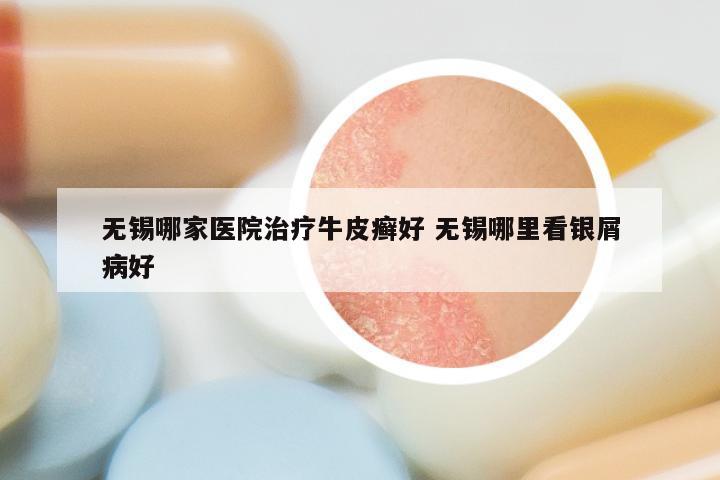 无锡哪家医院治疗牛皮癣好 无锡哪里看银屑病好
