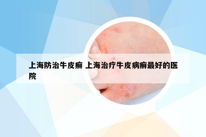上海防治牛皮癣 上海治疗牛皮病癣最好的医院