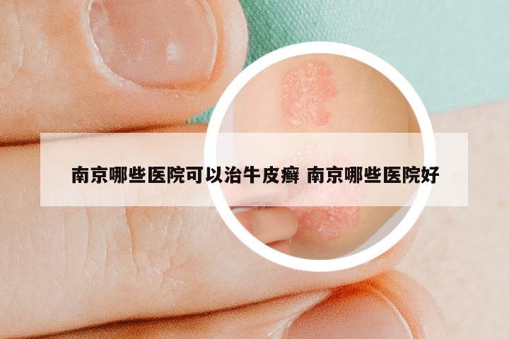 南京哪些医院可以治牛皮癣 南京哪些医院好
