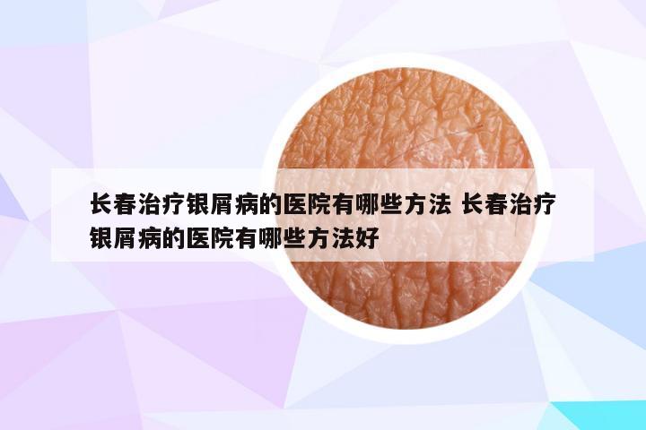 长春治疗银屑病的医院有哪些方法 长春治疗银屑病的医院有哪些方法好